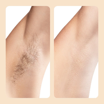 מכונת גילוח עדינה להסרת שיער של ByNibar