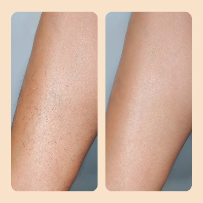 מכונת גילוח עדינה להסרת שיער של ByNibar