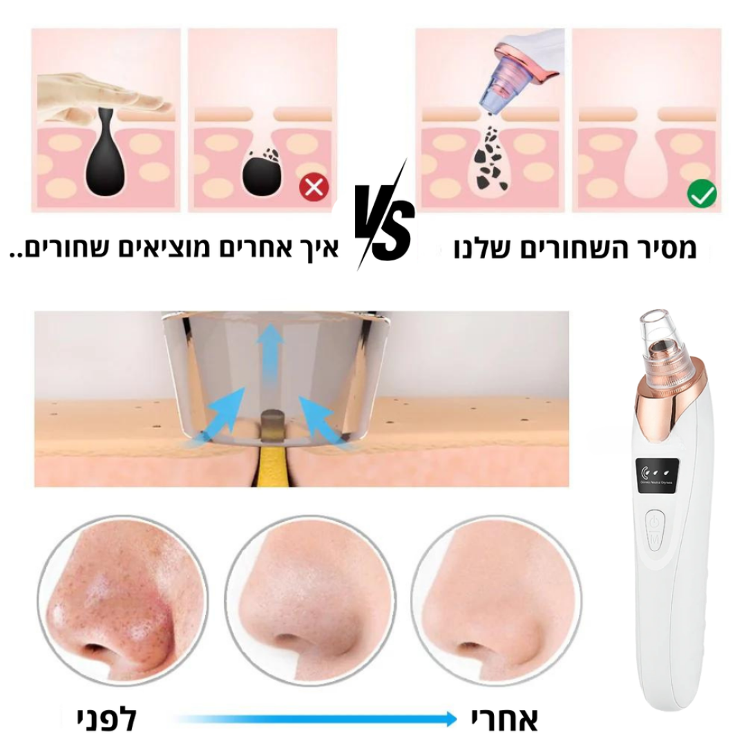 מכשיר להסרת שחורים באף של ByNibar